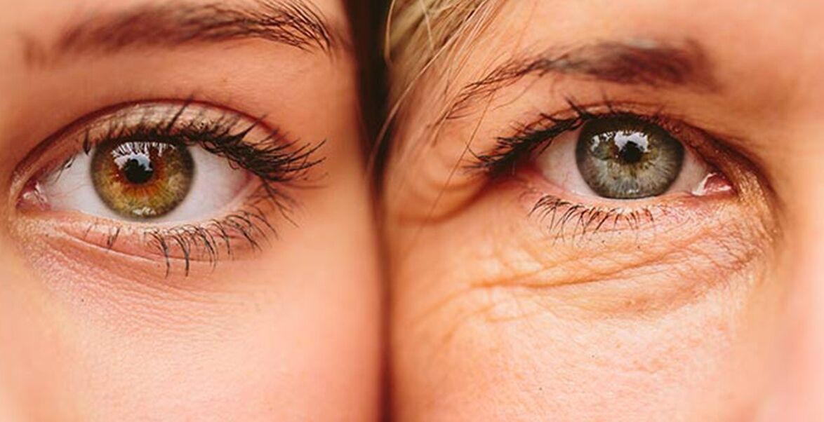 Signs of skin aging around the eyes in two women of different ages