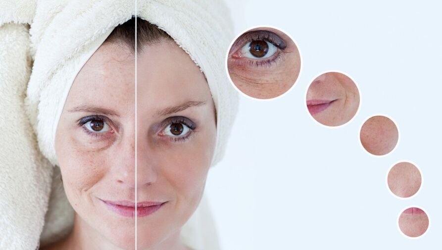 before and after plasma skin regeneration