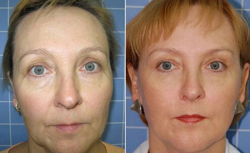 Before and after laser facial facial rejuvenation