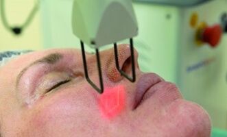 laser fractional recovery procedure