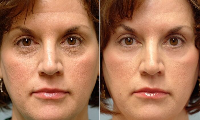 face before and after laser fractional regeneration