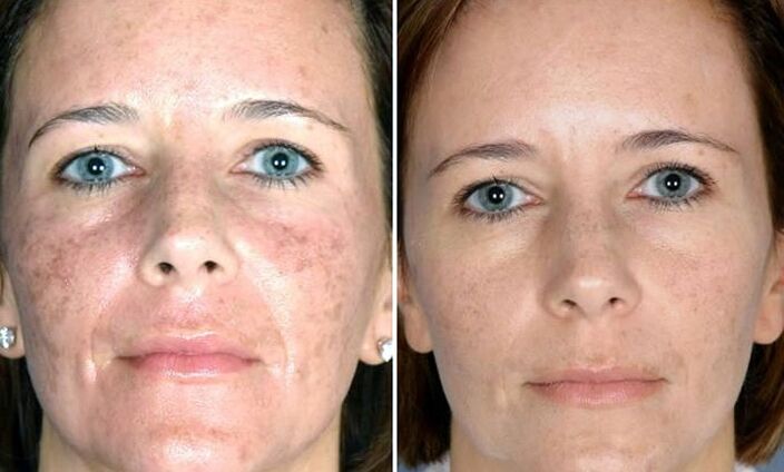 photo before and after fractional laser reconstruction
