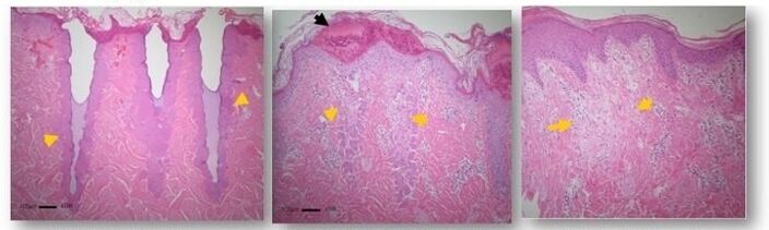 skin changes under a microscope after fractional regeneration