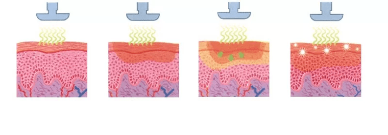 how the regenerative apparatus acts on the skin
